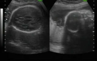 3D-Ultrasound